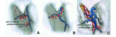 Diagrams Showing The Dissection Of The Sylvian Veins In Type Ii A
