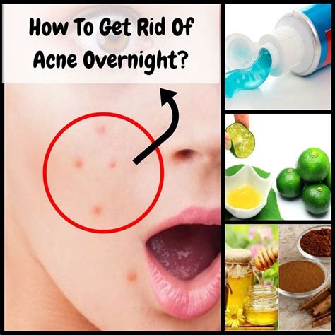Here Are The Natural And Powerful Ways Of Getting Rid Of An Acne