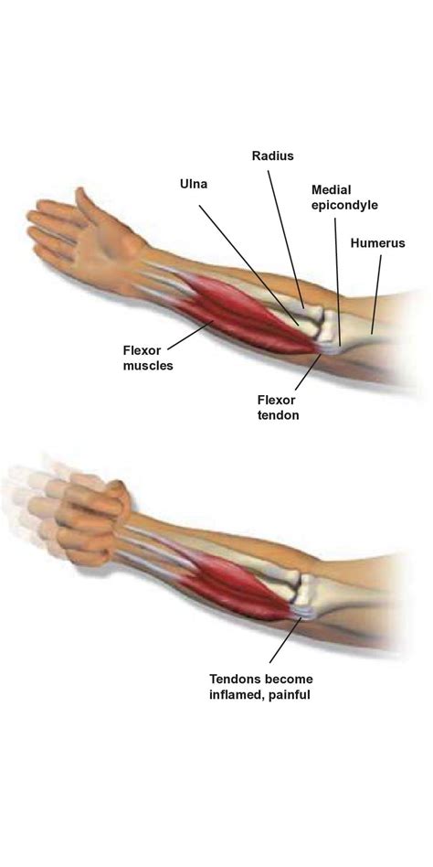 Medial Elbow Tendons Hot Sex Picture