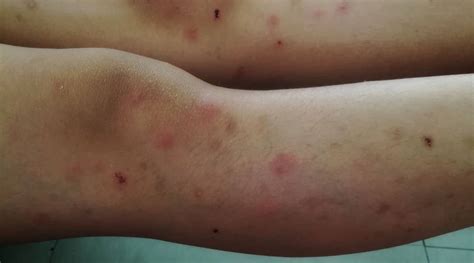 Bed Bug Bites On Legs Sales Cheapest Save Jlcatj Gob Mx