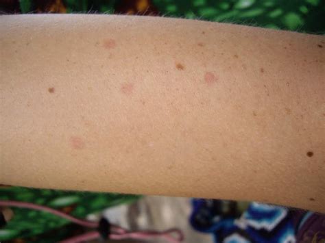 Henrietta Carlson Rumor Red Circle On Skin Not Itchy On Arm