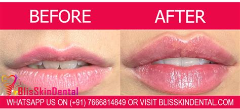 Cost Of Lip Filler Treatment In Bandra Mumbai Bliss Skin Hair And Dental