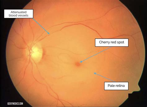 Central Retinal Artery Occlusion Crao Geeky Medics
