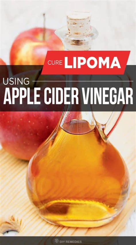 How To Cure Lipoma Using Apple Cider Vinegar