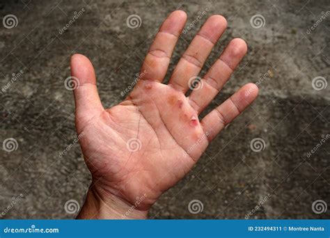 Blister On Hand From Overwork Wound On Right Hand Stock Image Image