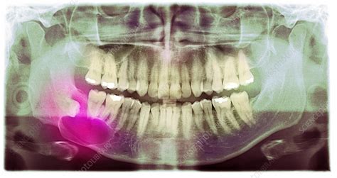 Impacted Wisdom Tooth Panoral X Ray Stock Image C0152820