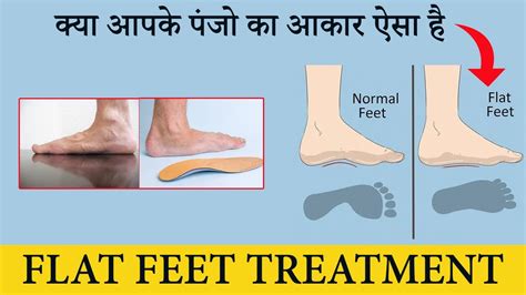 Flat Feet And Normal Feet How Flat Foot Walk Looks Like Flat Foot Symptoms In Hindi Youtube