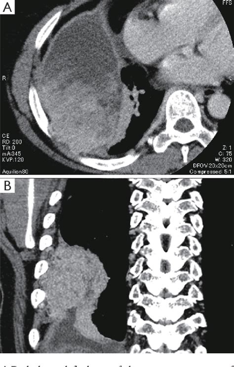 Figure 4 From Design Variations In Vertical Muscle Sparing Thoracotomy