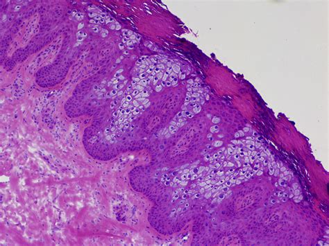 Epidermodysplasia Verruciformis In Mohs Micrographic Surgery Jaad