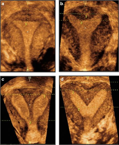 A Coronal D Us View Of A Normal Uterus Uterine Wall Thickness