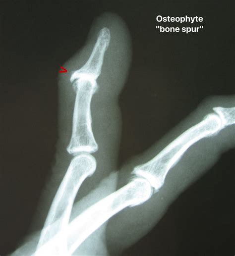 Hand Arthritis On X Rays Raleigh Hand To Shoulder Center
