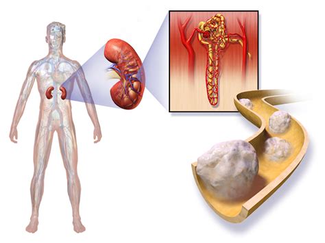 Removing the kidney prolongs survival and may be curative if cancer has not spread. Kidney Cancer: Overview, Symptoms and Treatment - HappyAging