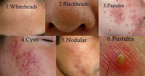 Types Of Acne Cystic Acne Treatment Oily Skin Treatment Back Acne