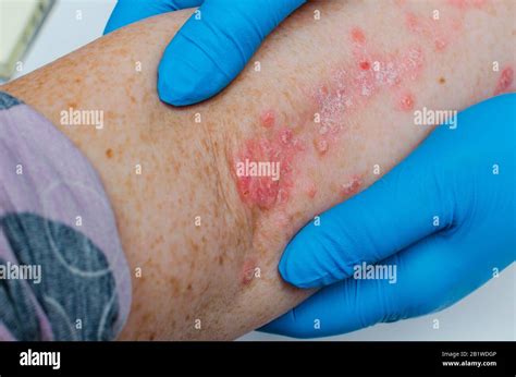Diagnosi Di Malattie Della Pelle Allergie Psoriasi Eczema