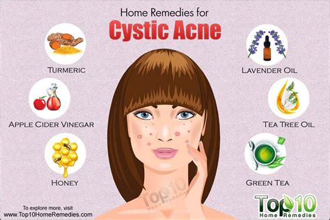 Home Remedies To Get Rid Of Lice Home Remedies Cystic Acne