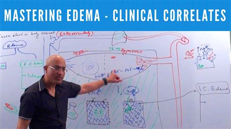Mastering Edema Types Causes Symptoms And Treatment 👨‍⚕️ Youtube