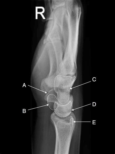 Lateral Wrist Radiograph Anatomy