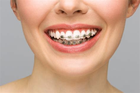 Tratamiento De Ortodoncia Cuando Empezar Alinear Dentaelen Clínicas