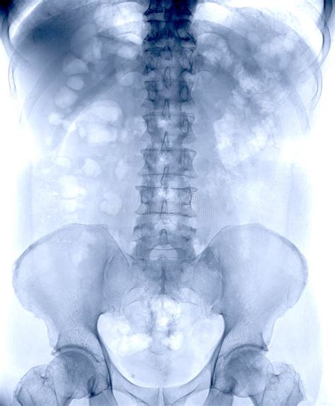 Abdomen Radiography Stock Image Image Of Modern Backbone 1533985