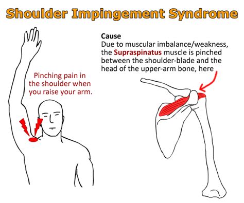 How To Treat Shoulder Impingement Physical Therapy Physciq