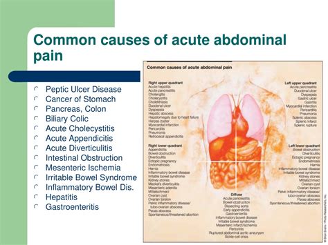 Ppt Approach To The Patient With Acute Abdominal Pain