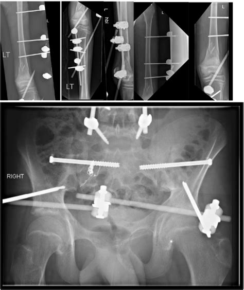 Post Operative Radiograph Eight Weeks Of The Pelvis And Left Femur