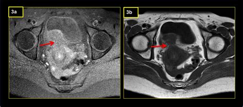 Figure Mri Of The Pelvis 3a And 3b Axial T1 Fat Sat And Axial T2