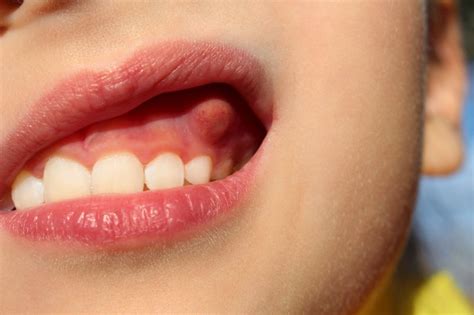 Dentist Gum Boils Bumps Longmont Complete Dentistry
