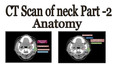 Ct Scan Of Neck Axial Part 2 Anatomy Youtube