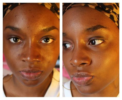 How To Treat Acne Scars On Black Skin Surffishinga