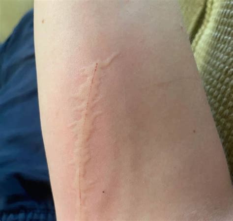 Do Cat Scratches Leave Permanent Scars How To Remove