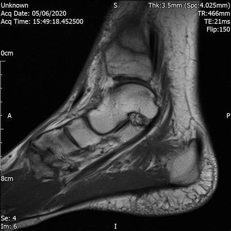 Undisplaced Fracture Distal Tibial Metaphysis Cases Home