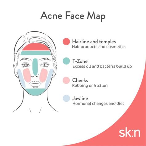 Use Our Acne Face Map To Find Out What Type Of Breakout Youve Got Skn Clinics