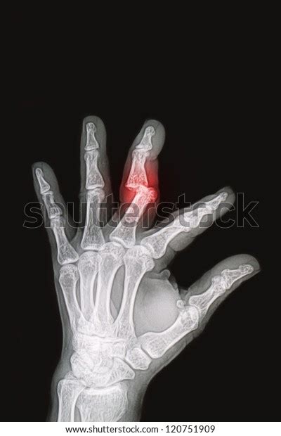 Wrist Hand Xrays Image Show Fracture Stock Photo Edit Now 120751909