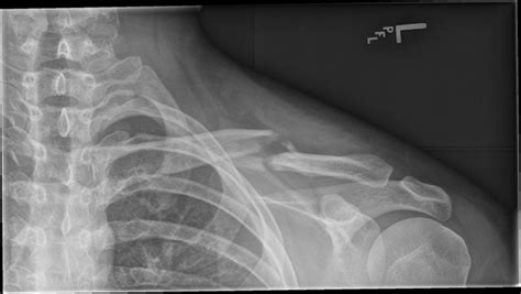 Ortho Dx How Would You Treat This Clavicle Fracture Clinical Advisor
