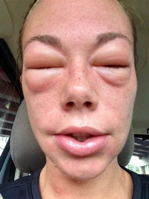 Allergic Reaction Face Swelling