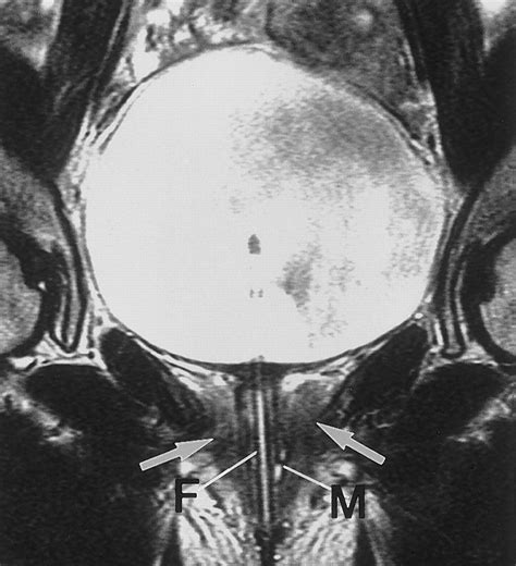 Mr Imaging Of The Male And Female Urethra Radiographics