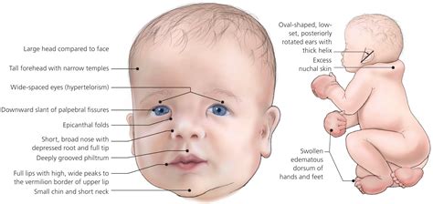 Picture Of Noonan Syndrome