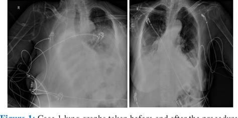 Figure 1 From Treatment Experience Of Total Atelectasis With