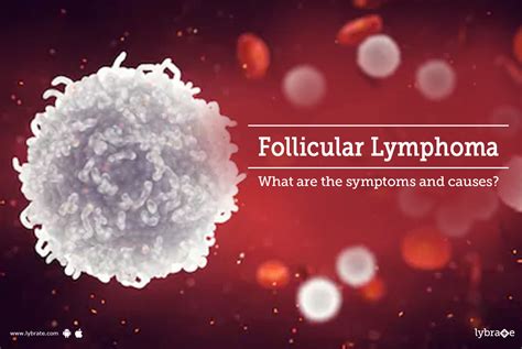 Follicular Lymphoma What Are The Symptoms And Causes By Dr Garima