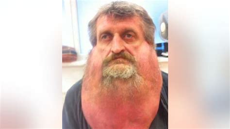 Man To Undergo Second Surgery To Remove 14 Pound Tumor From Face Fox News