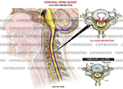 C4 5 Central Disc Herniation — Medical Art Works