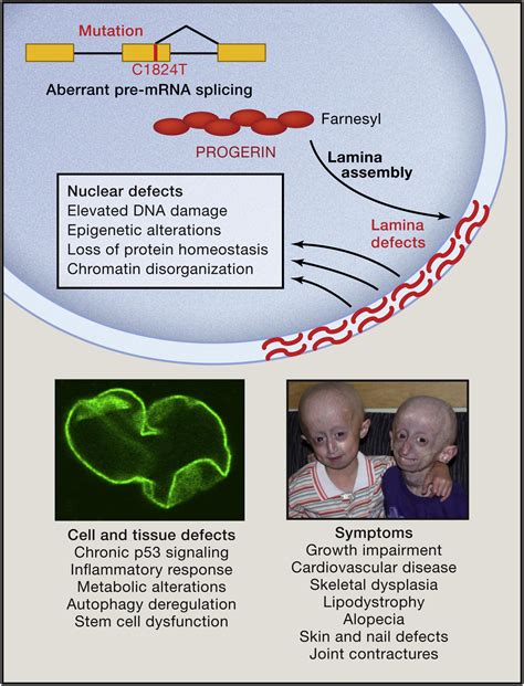Progeria A Paradigm For Translational Medicine Cell