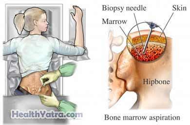 Maybe you would like to learn more about one of these? Best Cost Bone Marrow Biopsy Surgery, Treatment Hospital ...