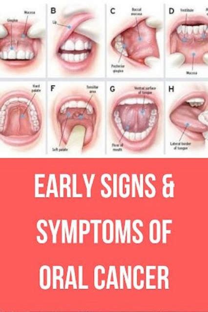 Early Signs And Symptoms Of Oral Cancer Guide To Health