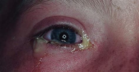 Study Medical Photos Bacterial Conjunctivitis A Brief Introduction