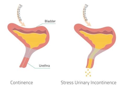Stress Urinary Incontinence In Relation To Pelvic F Research Hot Sex