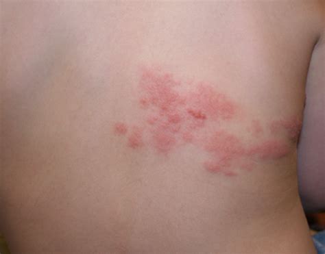 Shingles Rash Pictures