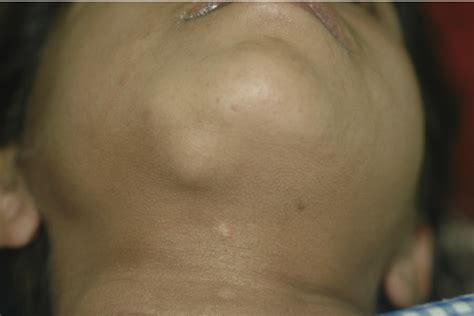 Clinical Photograph Of Patient 1 Showing A Swelling In Right