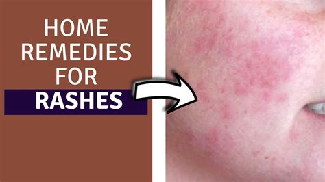 Home Remedies For Rashes How To Get Rid Of Rashes Fast Home